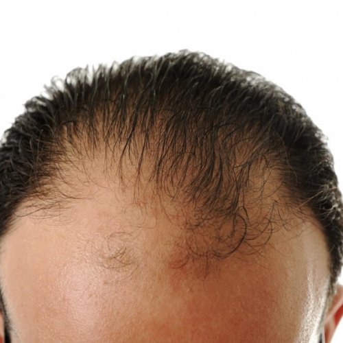 תוספות שיער לגברים